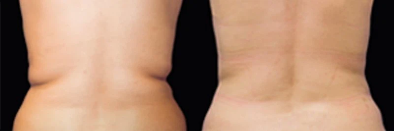 love handle fat freezing 3