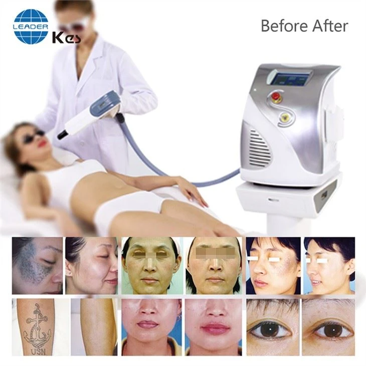 Qswitch ND YAG Laser
